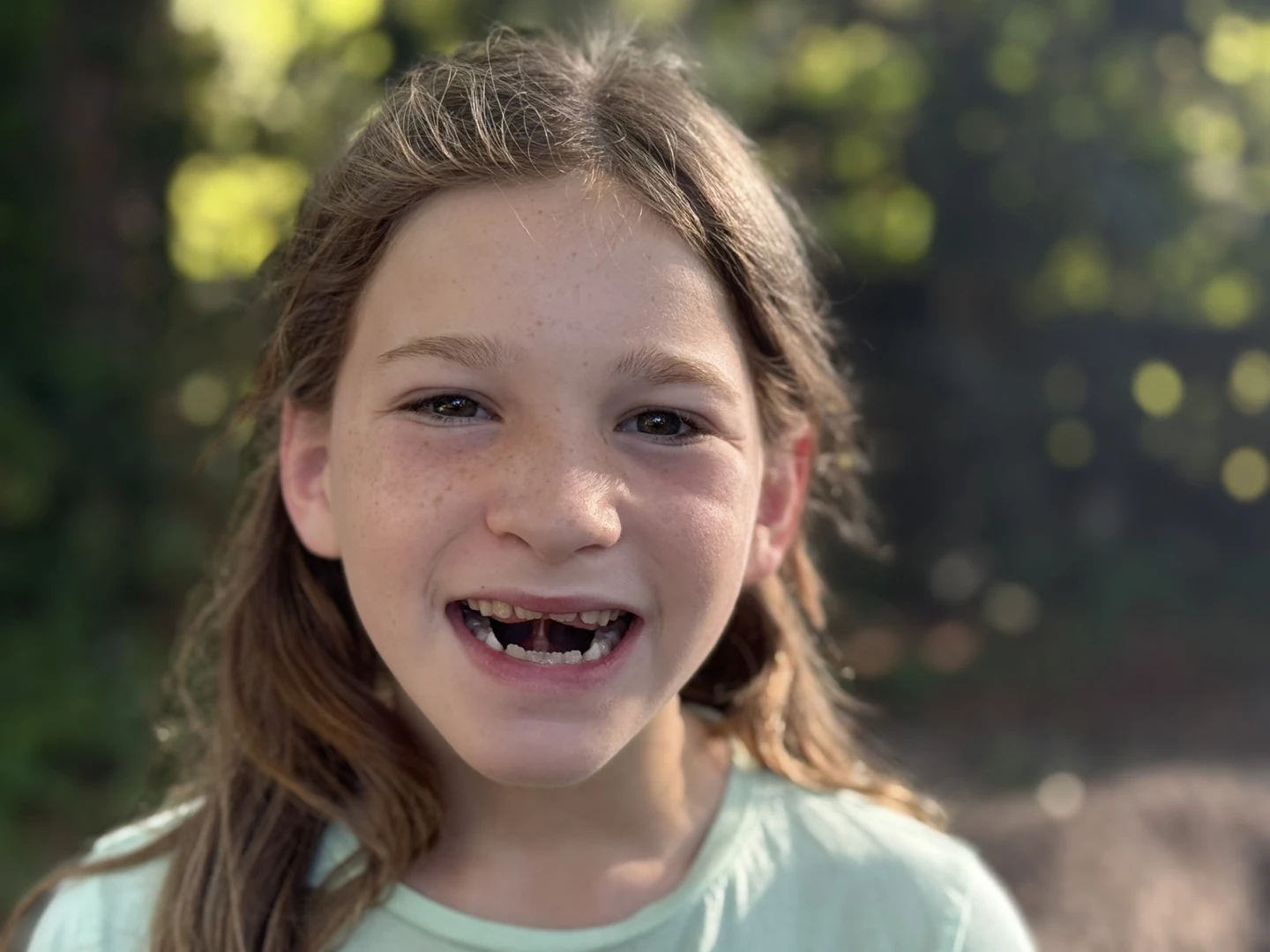 Frenectomy for Children